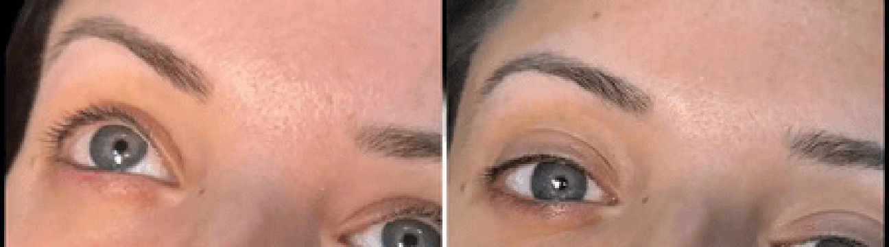 Dermal Fillers